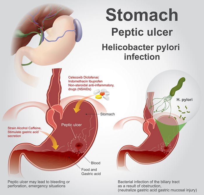 Dyspepsia Or Indigestion 5 Common Causes And Symptoms 